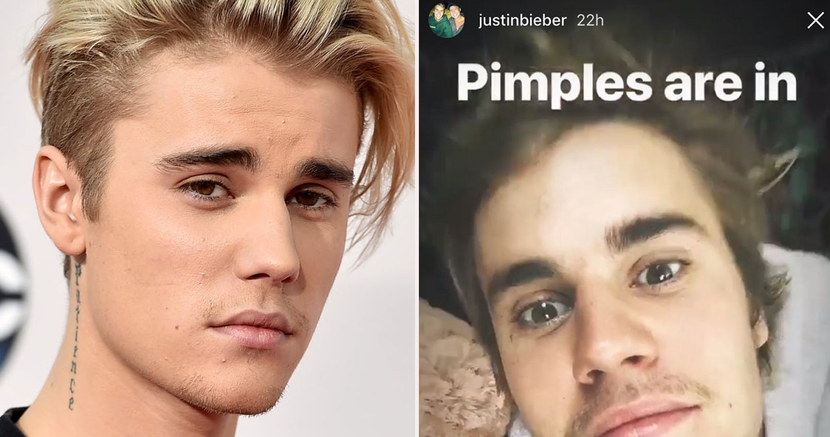 From Pimples To Perfection... How Justin Bieber Got His Skin In Check