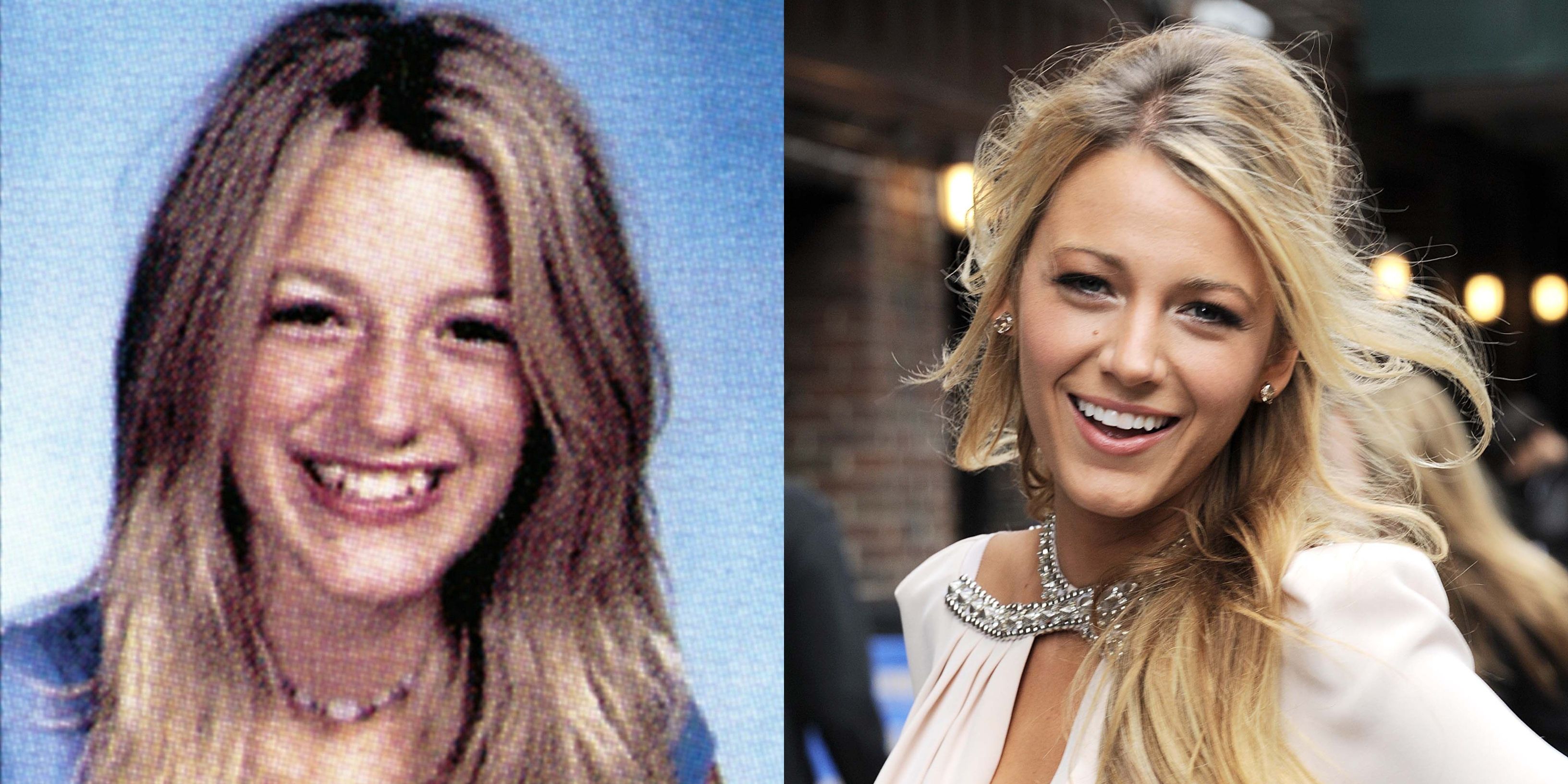 10 Celebs We Totally Forgot Had Their Teeth Fixed | TheThings